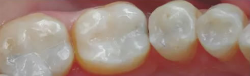 Fillings and Crowns - After