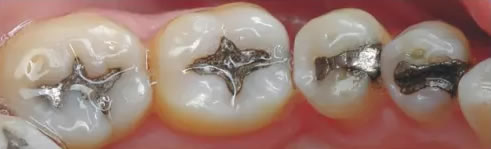 Fillings and Crowns - Before