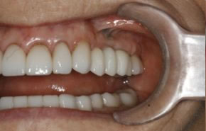 Smile Gallery - Implants